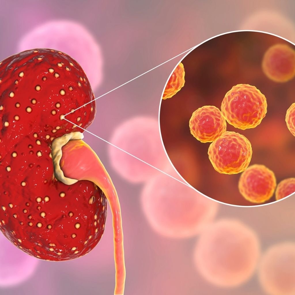Recurrent Kidney Infections