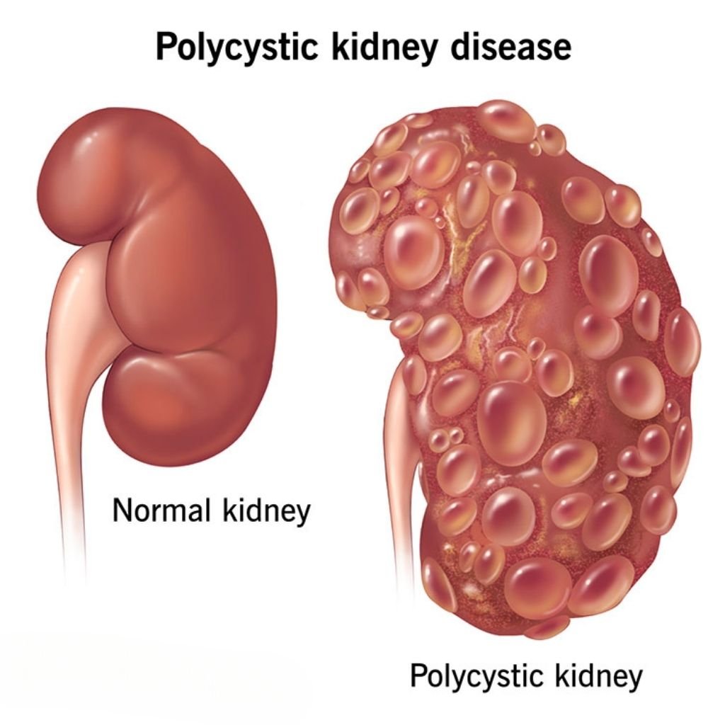 polucystic kidney disease treatment