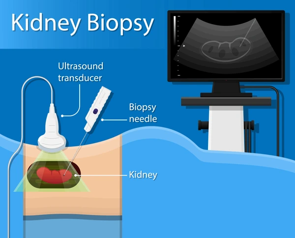 Kidney Biopsy in Ahmedabad
